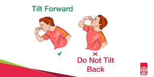 tilt your head back during a nosebleed